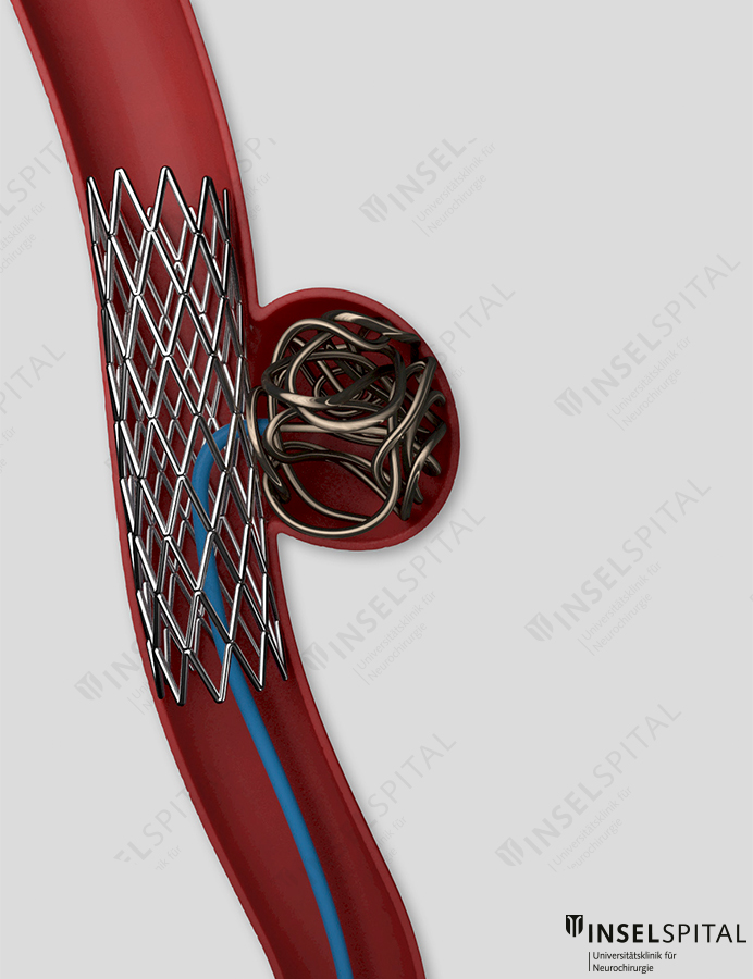 aneurysma coiling 3d Visualisierung