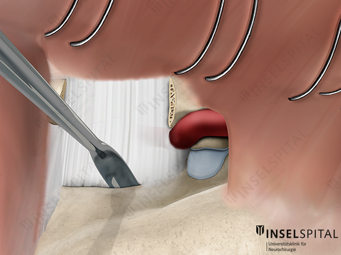 Illustration far lateral approach