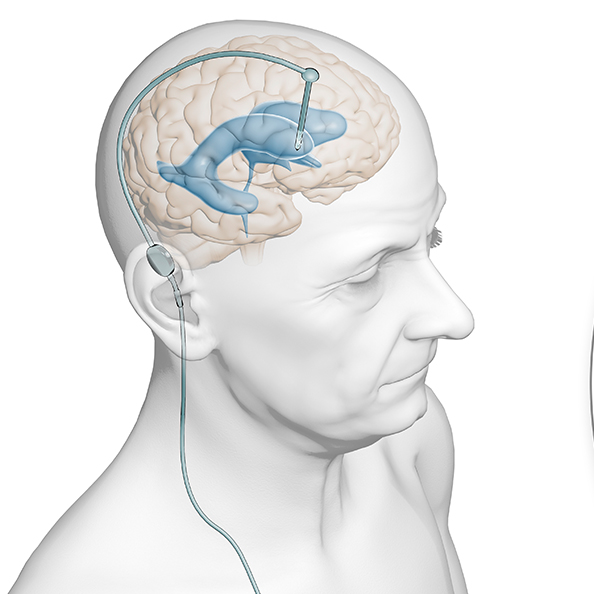 Bilderkram - Wissenschaftliche Illustration - Shunt Hydrocephalus
