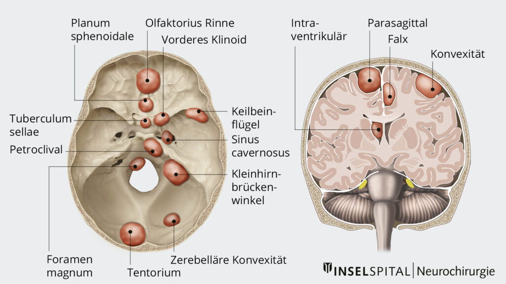 Illustration Meningeome Lokalisationen