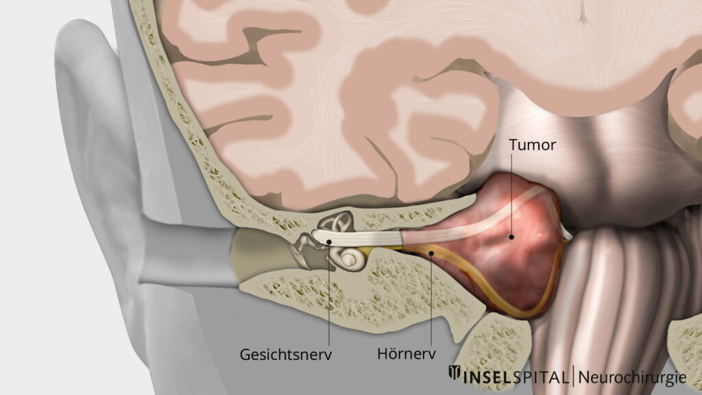 Illustration Vestibularisschwannom