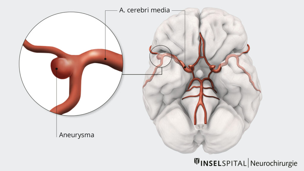 Illustration Aneurysma an der mittleren Hirnarterie 