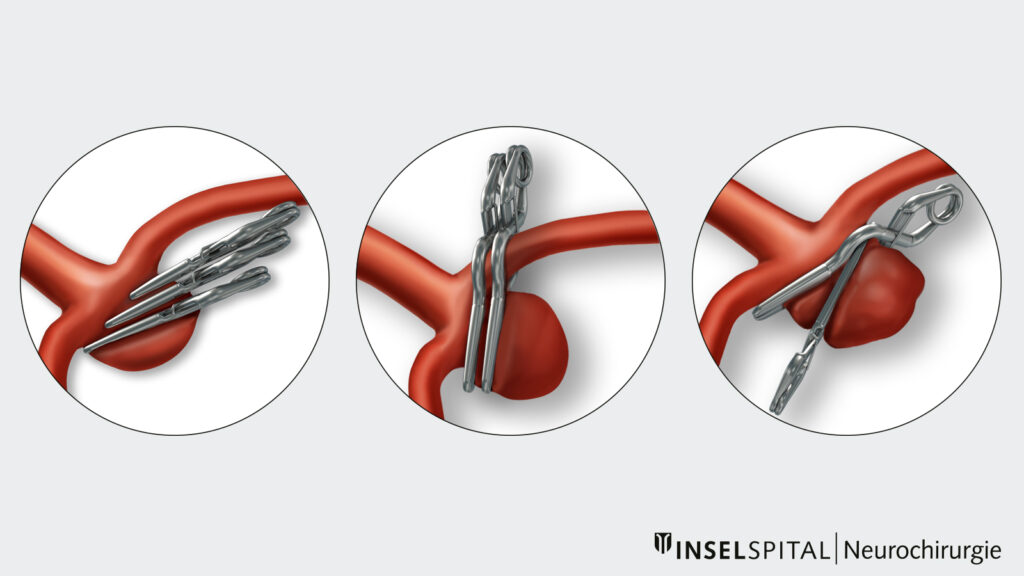 Illustration Aneurysma Clipping Varianten