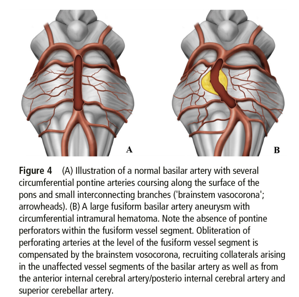 Illustration arteria basilaris