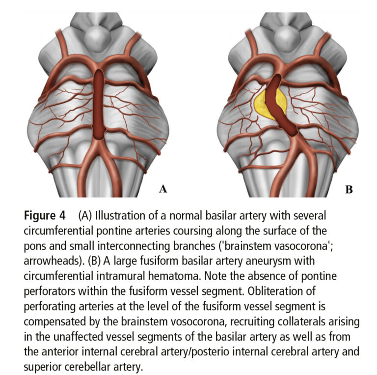 Arteria Basilaris