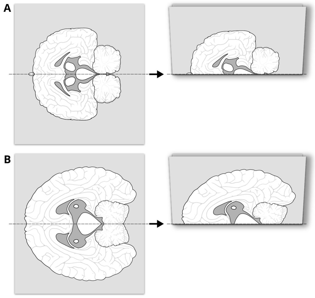 Illustration Schematische Rekonstruktion von Leonardos „geöffneter“ Präparation eines Gehirns